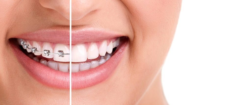 The Importance Of Orthodontic Treatment For Your Smile