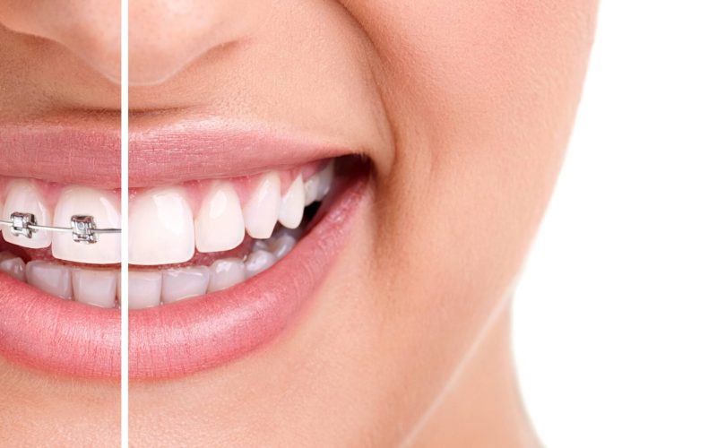 The Importance Of Orthodontic Treatment For Your Smile